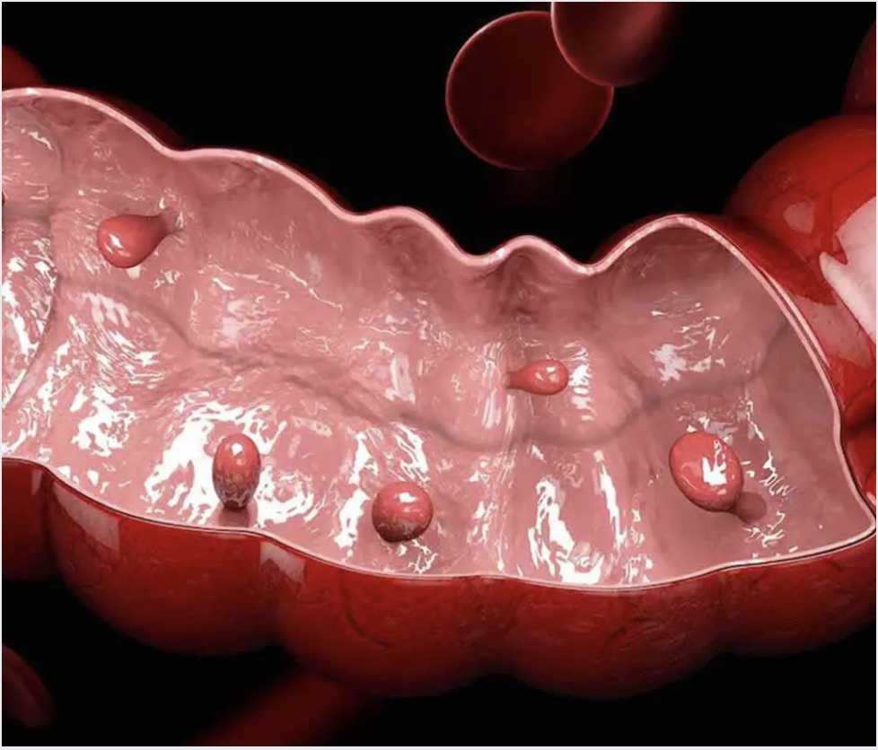 Bowel Cancer: Know the Signs, Reduce the Risk, Get Checked
