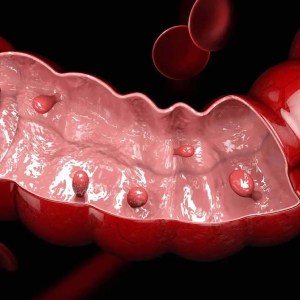 Bowel Cancer